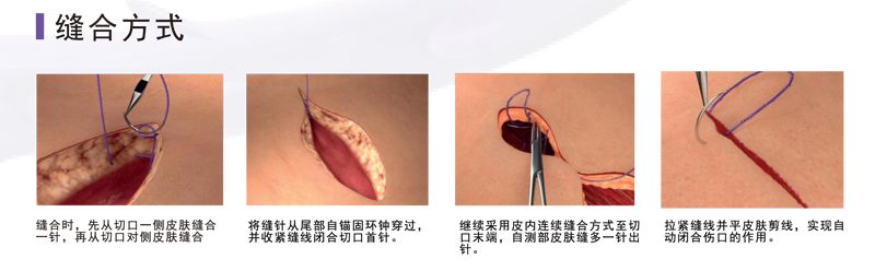 可吸收带倒刺缝线(鲁械广审(文)第260914-15660号)